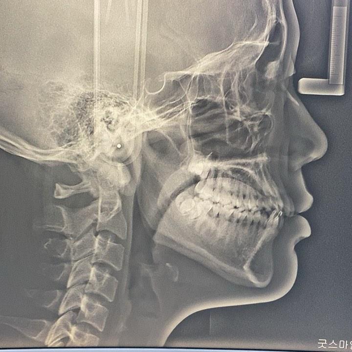 total arch retraction
#blackshaqgoodsmile #orthod…