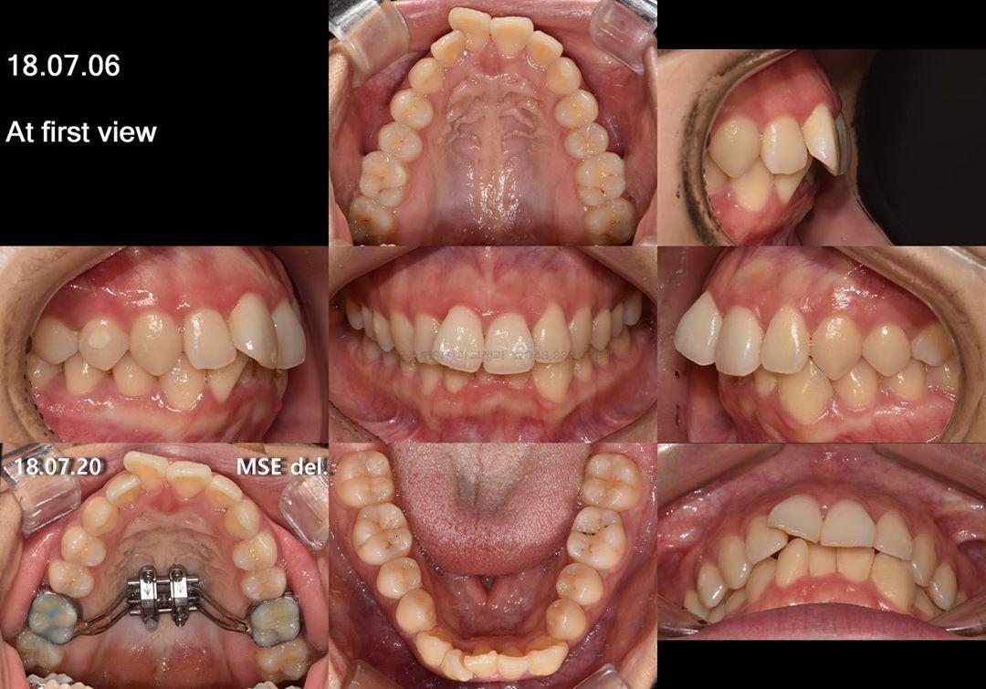 camouflage treatment of 3 mandibular incisors
#bl…