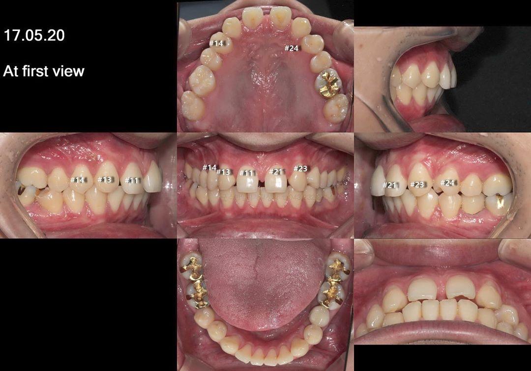 Camouflage treatment of skeletal class II dental c…