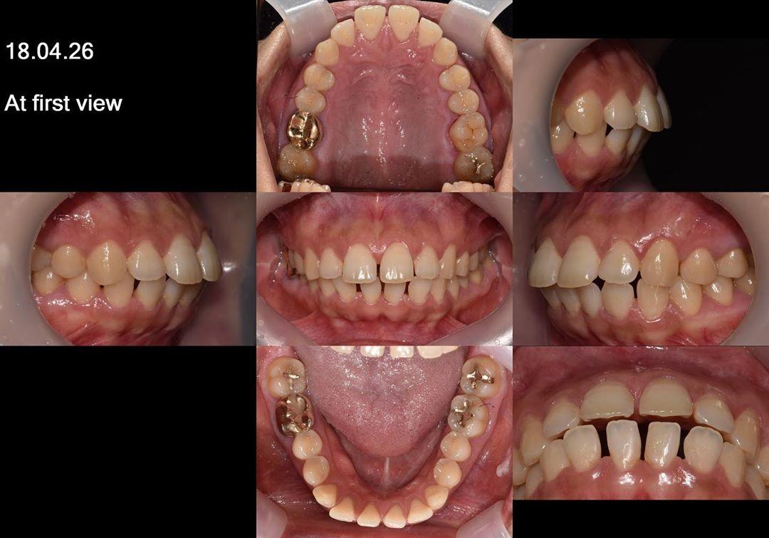 camouflage treatment of skeletal class II with gen…
