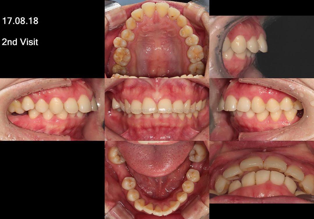 camouflage treatment of skeletal class II with gum…