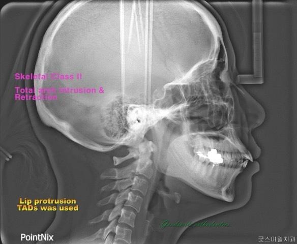 Non extraction
Total arch movement for middle aged…
