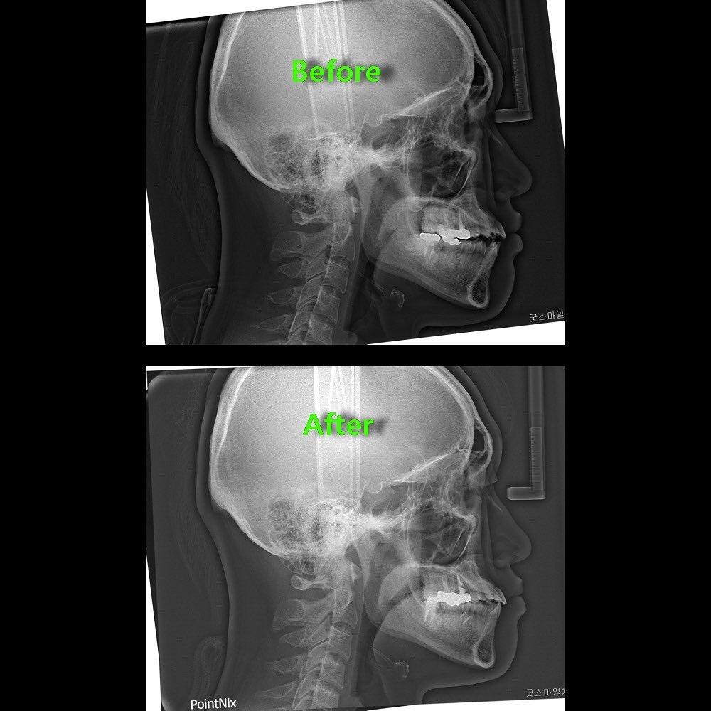 camouflage treatment of skeletal class III with ma…