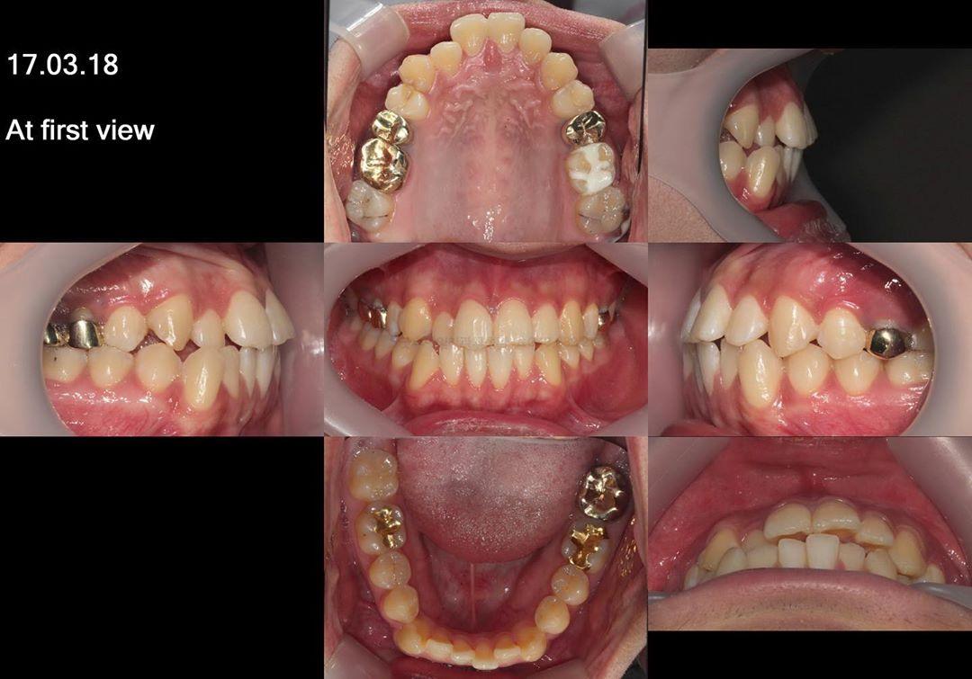 camouflage treatment of skeletal class III with ma…