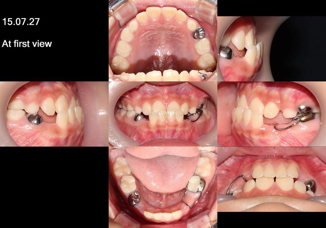 Treatment of skeletal class III, dental class III
…
