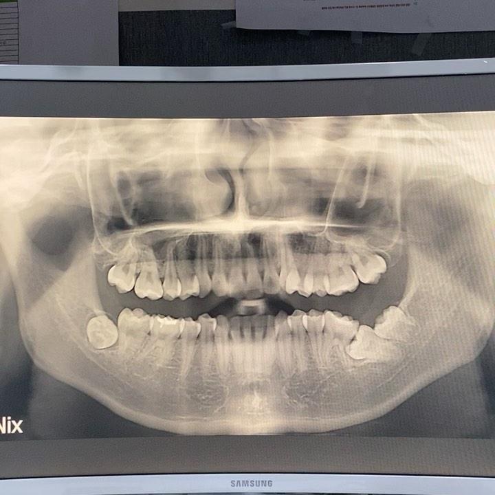Treatment of horizontal impaction of left mandibu…