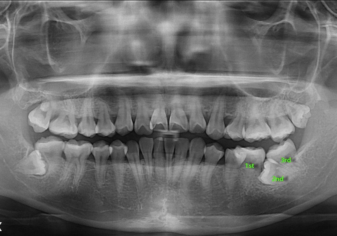 Camouflage treatment of skeletal Class IIII with l…