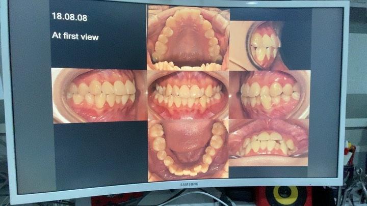 Camouflage treatment of skeletal Class III with ma…