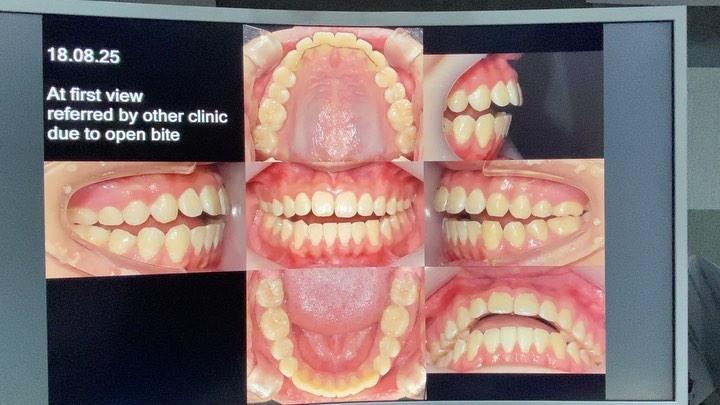 treatment of skeletal class I, dental open bite
1…