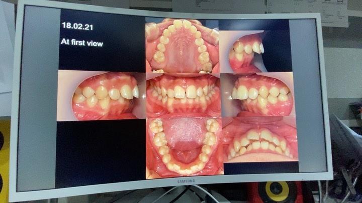 Non extraction treatment of skeletal Class II with…