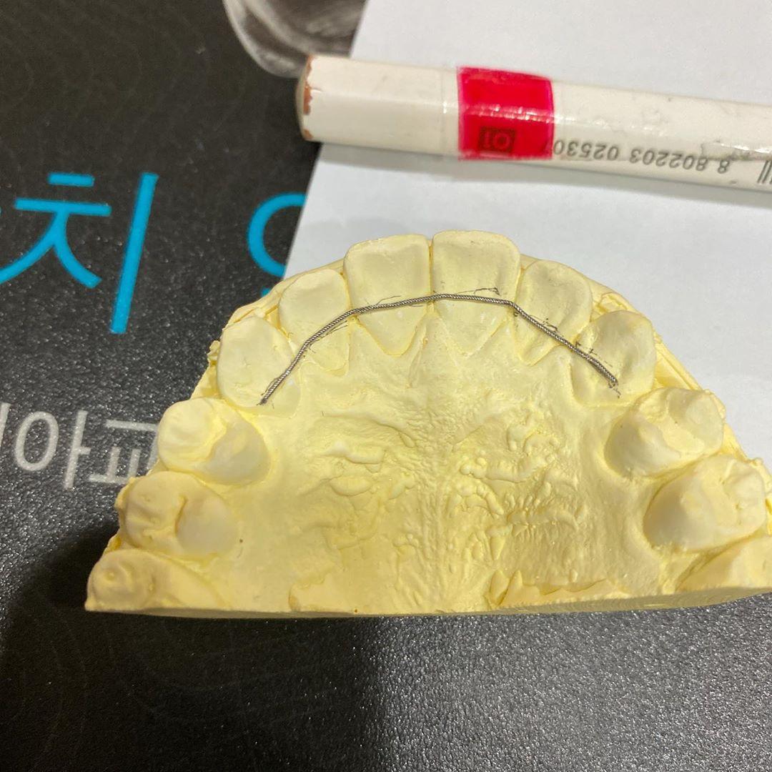 12년간 내 픽스드 내가 접고 붙이는데 왜케 완벽하게 못할까ㅜㅜ 치아에 붙이면 또 완벽하게…