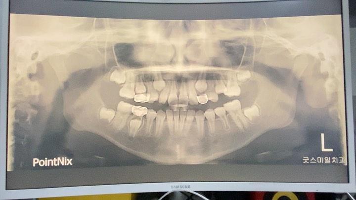 nonextraction treatment of #13 impaction and poste…