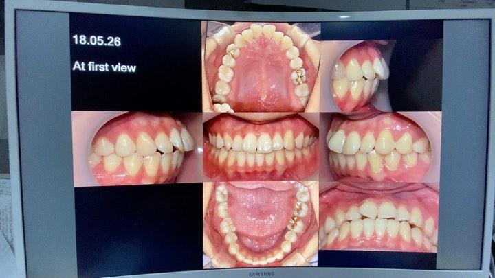 Treatment of skeletal Class III with lip redundanc…