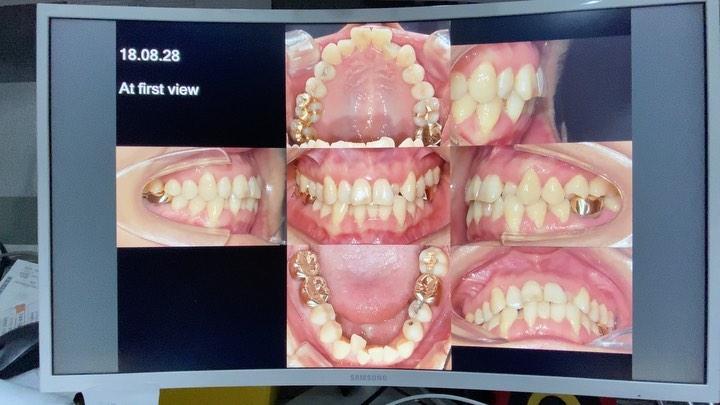 Non extraction treatment of skeletal Class III wit…