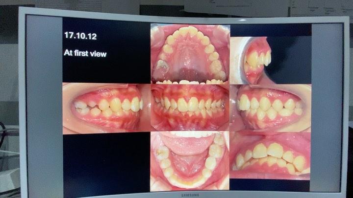 treatment of skeletal class II with mn sl def dent…