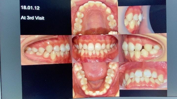 Camouflage treatment of skeletal Class III with de…