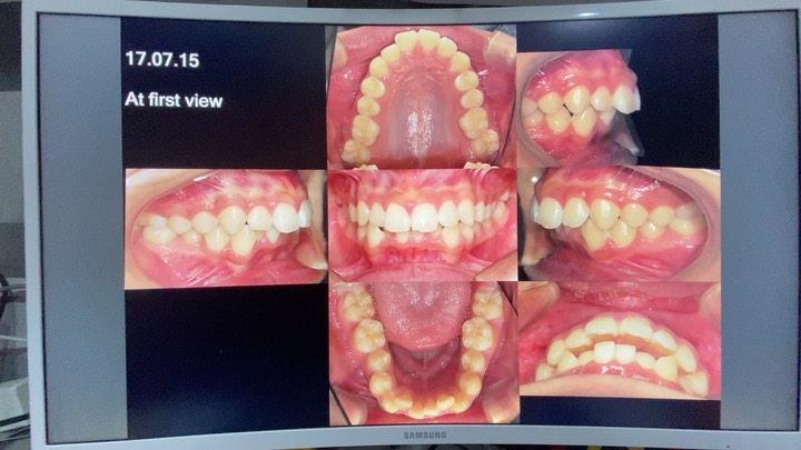 Camouflage treatment of skeletal Class II with lip…