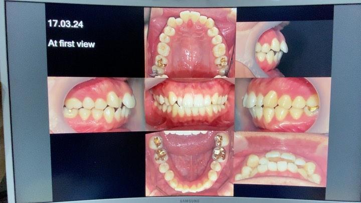 Camouflage treatment of skeletal Class II with man…