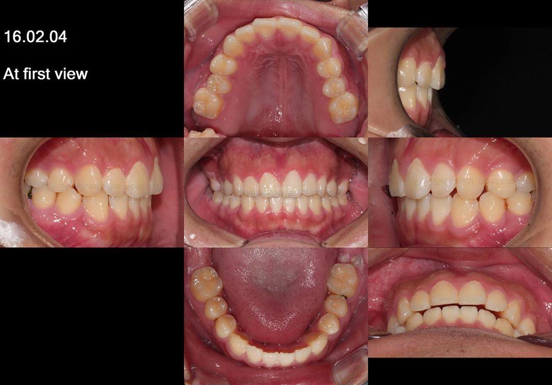 Treatment of Four 2nd molar abnormal impactions
#…