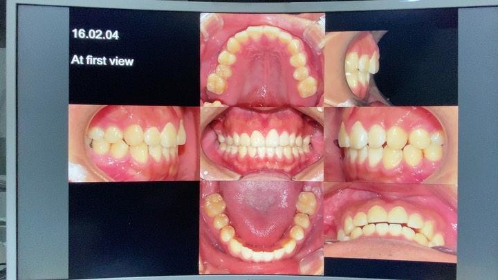 Treatment of 4- impacted second molars impaction
…