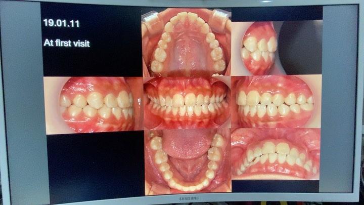Camouflage treatment of skeletal Class III with ma…