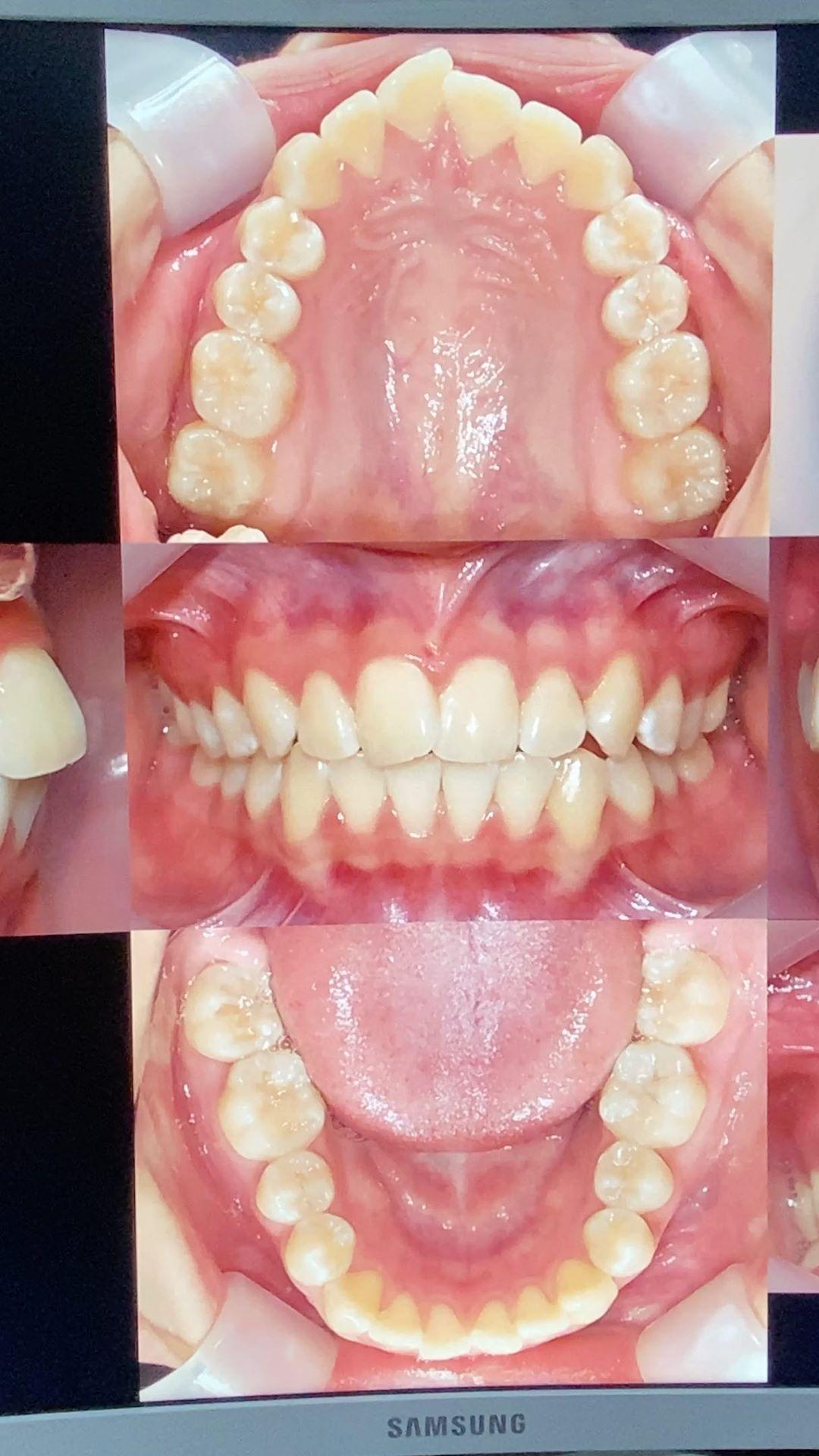 total arch retraction using tads
1. DBS 022 MBT CL…