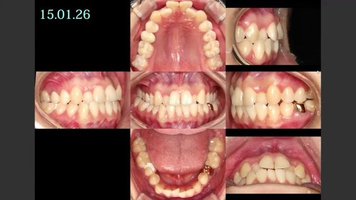Camouflage treatment of skeletal Class III with ma…