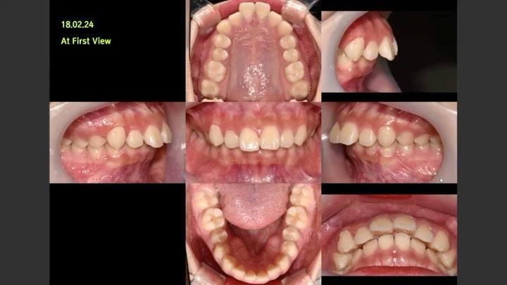 Camouflage treatment of skeletal Class II with low…