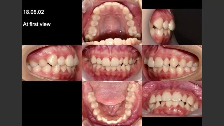 Camouflage treatment of Skeletodental dysplasia, s…