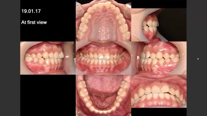 Camouflage treatment of skeletal Class III with ma…