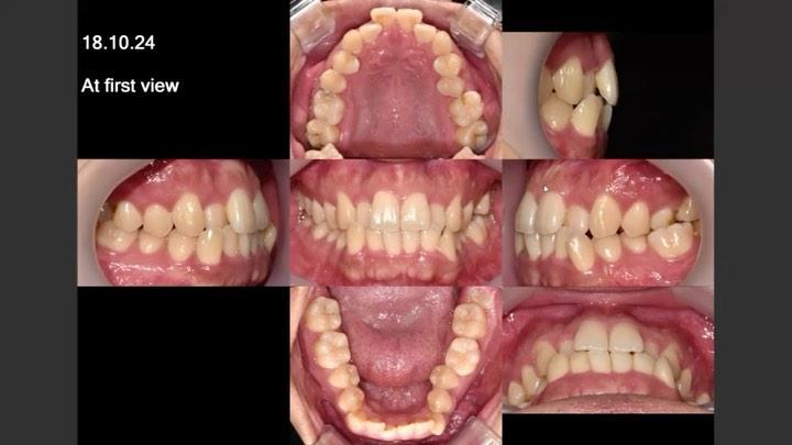 Camouflage treatment of skeletal Class III WITH mn…