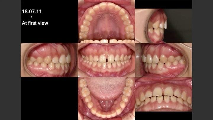 Camouflage treatment of skeletal Class III with ma…