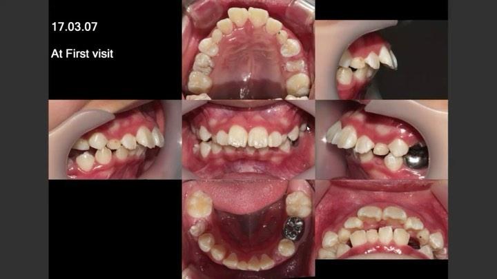 Camouflage treatment of skeletal Class II, Dental …