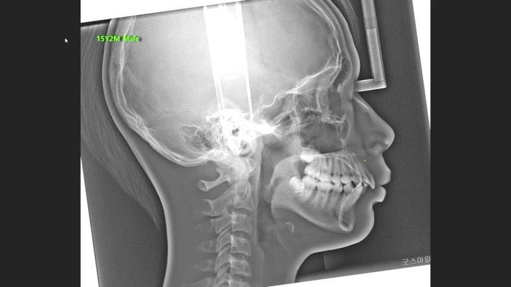 How about this patient?
1. Point A was retracted …