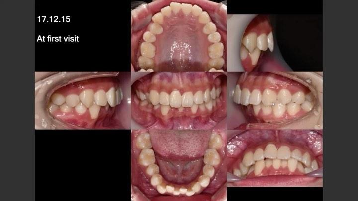 Camouflage treatment of skeletal Class II, Dental …
