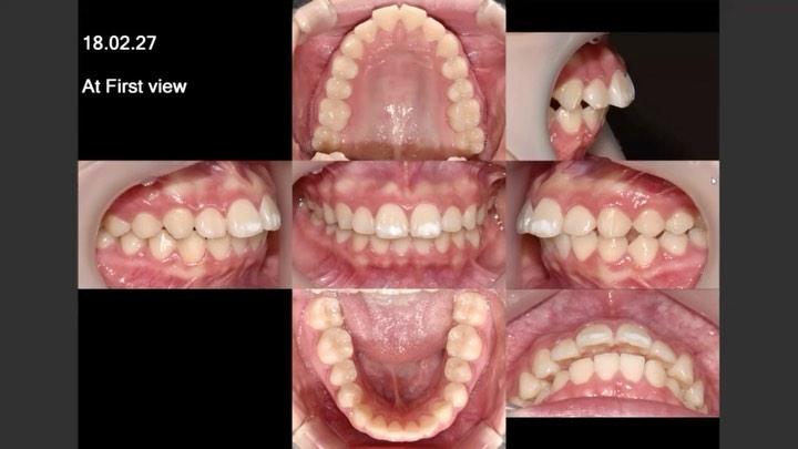 Treatment of severe lip protrusion by using OMI
1…