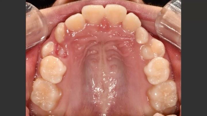 Treatment of headgear for distalization of upper 1…