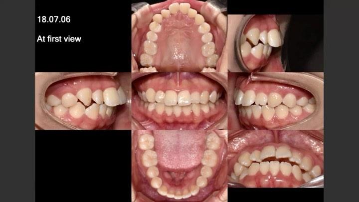 Camouflage treatment of Class I with lower 3 incis…