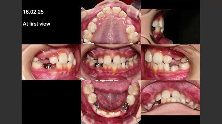 Nonextraction treatment of severe crowding for hyp…