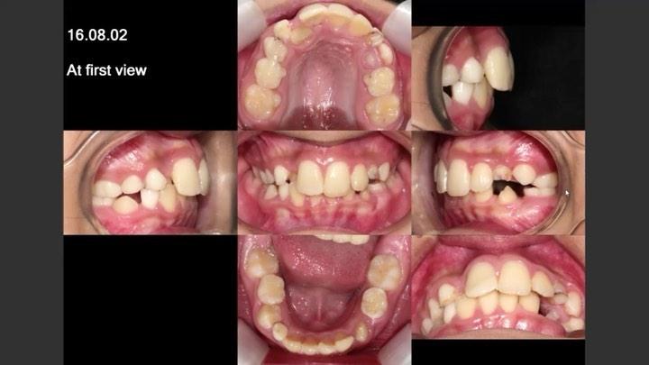 Treatment of skeletal Class II, hyperdivergent pat…