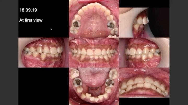 Retreatment of relapsed patient
she wanted to get…