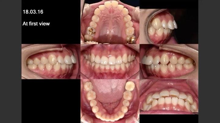Treatment of skeletal Class II with gummy smile by…