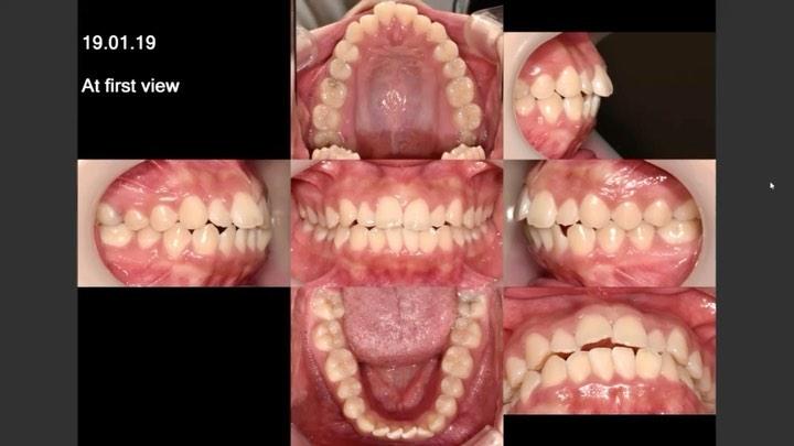 Total arch retraction treatment case of skeletal C…