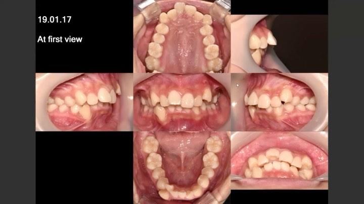 Non extraction treatment of skeletal Class II, Den…