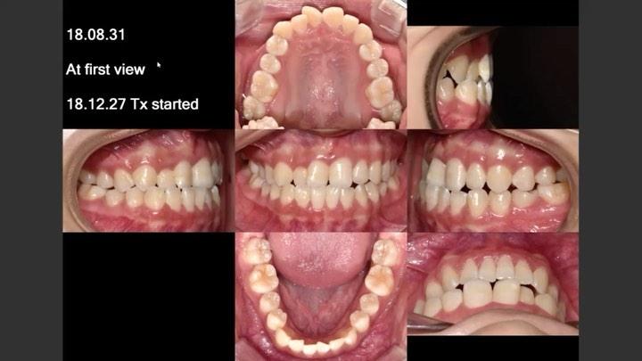 Camouflage of skeletal Class III with mandibular a…