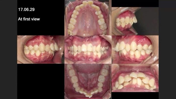 Camouflage treatment of dental Class II with sever…