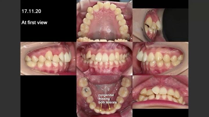 Camouflage treatment of skeletal Class II with wel…