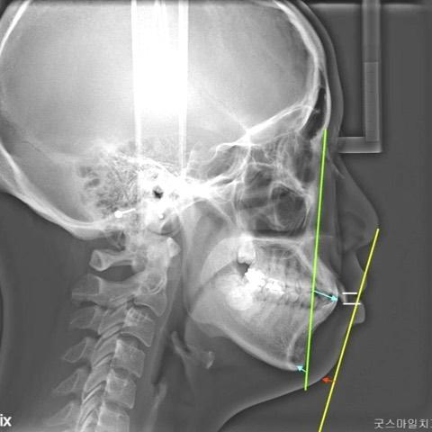 Mandibular autorotation of gummy smile patient
#bl…
