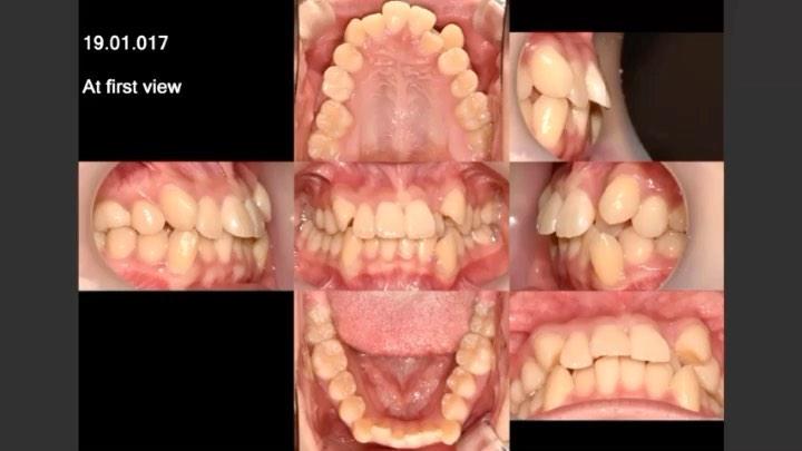 Non extraction treatment of skeletal Class III wit…