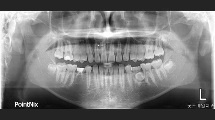 Unilateral mandibular molar protraction when lower…